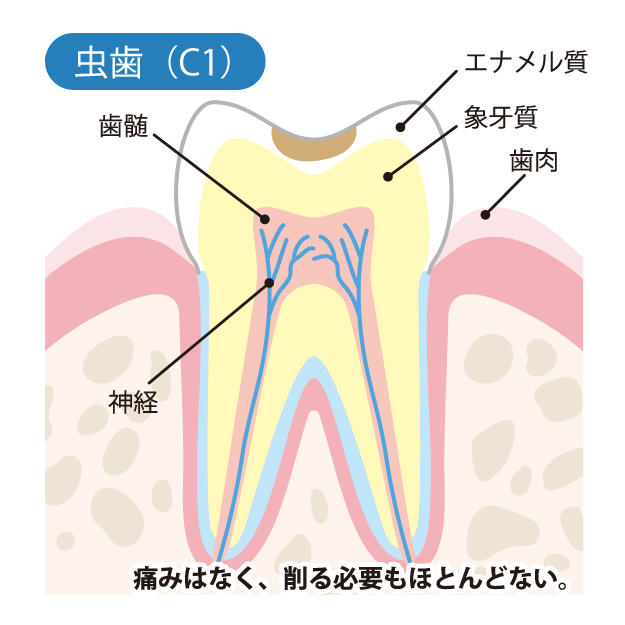 C1 歯の表面（エナメル質）のむし歯