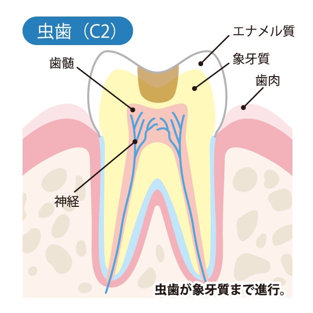 C2 歯の内面（ぞうげ質）のむし歯